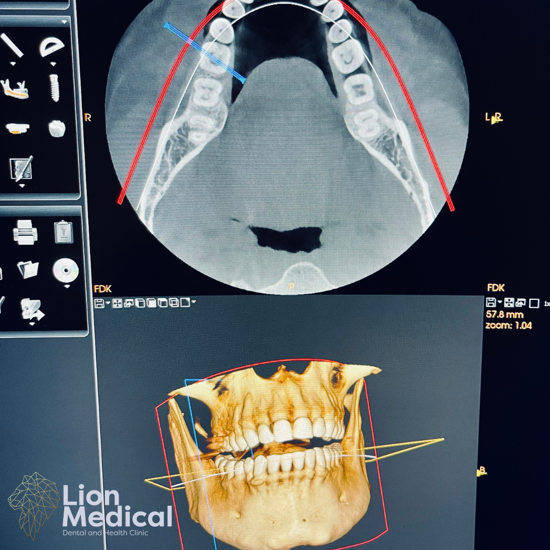 3D CBCT dental scan at Lion Medical Dental Clinic Dublin