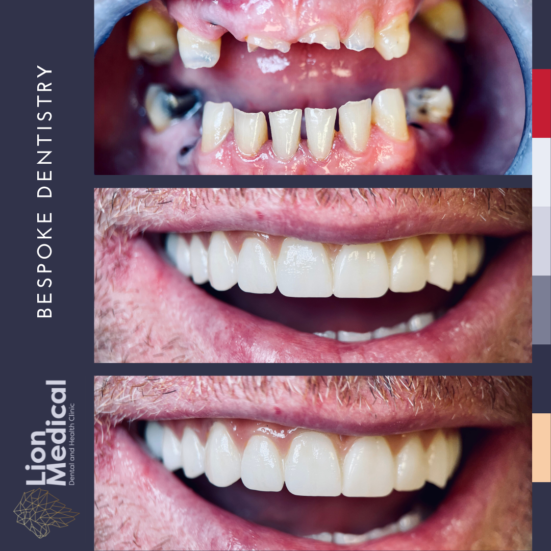 Dental implants and Full Mouth Restoration treatment for missing teeth at Lion Medical Dublin