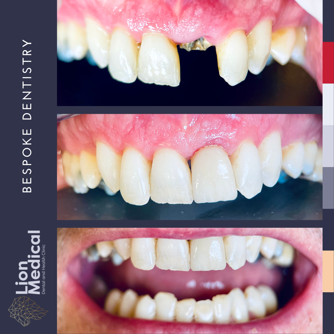 Dental Implants Dublin – Lion Medical Dental implants treatment for missing teeth at Lion Medical Dublin