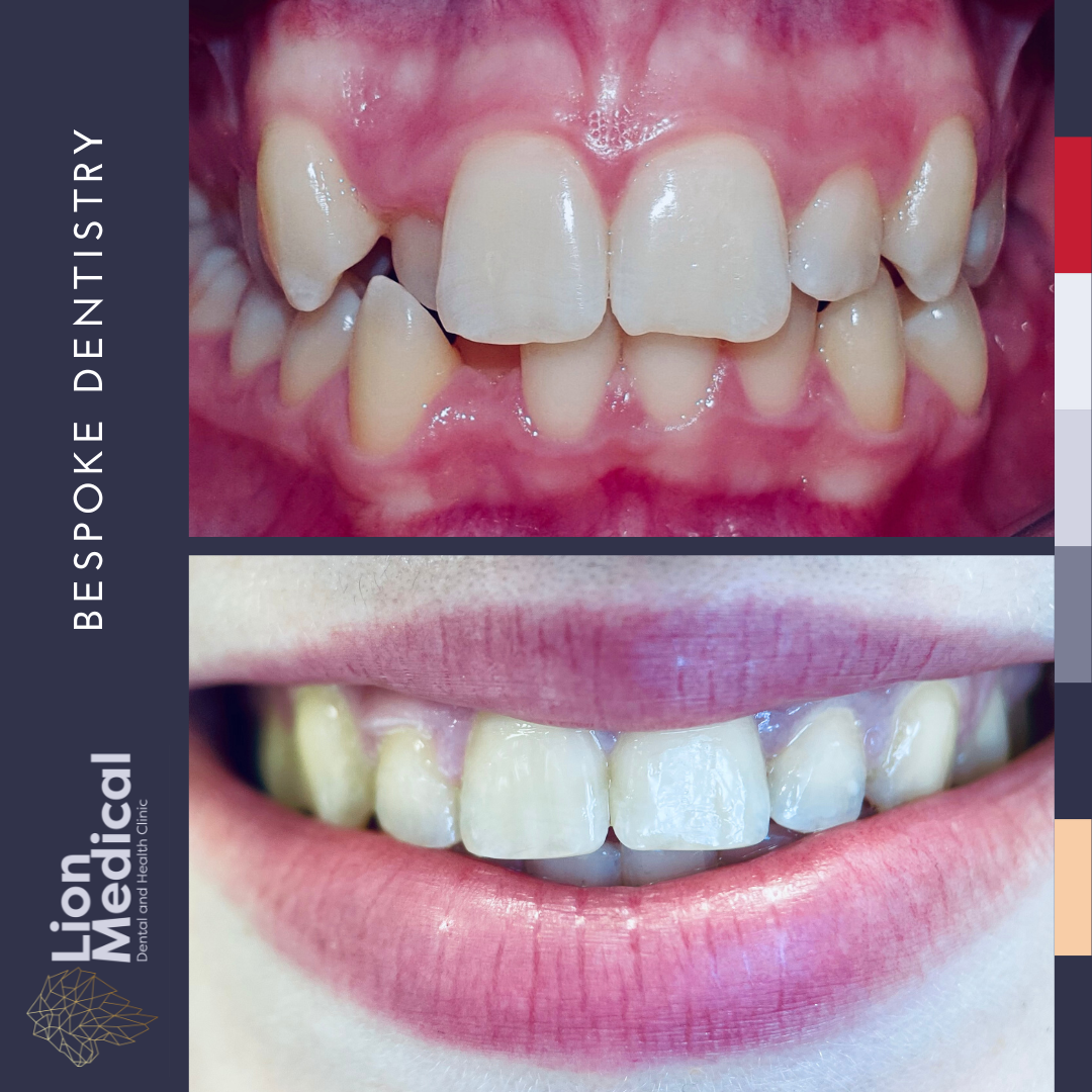Orthodontics & Invisalign Dublin – Lion Medical Invisalign clear aligners orthodontic treatment at Lion Medical Dublin